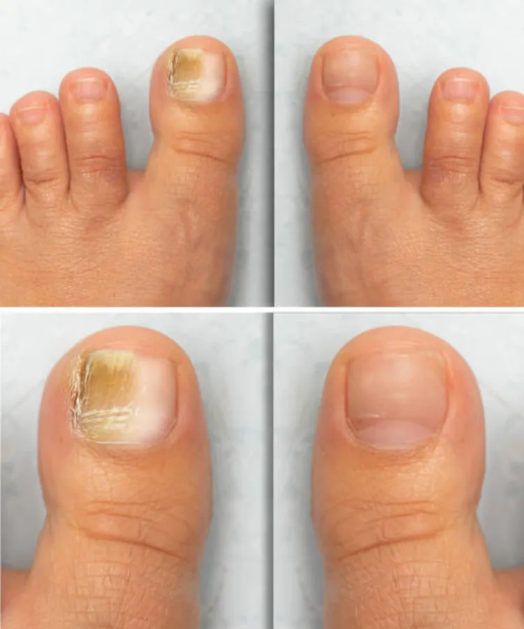 Toenail Fungus